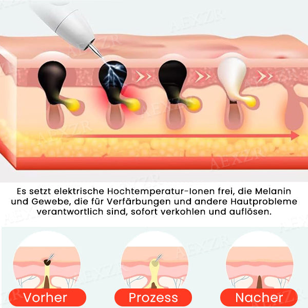Laser Hautpflege Stift für Pigmentflecken und Hautunreinheiten