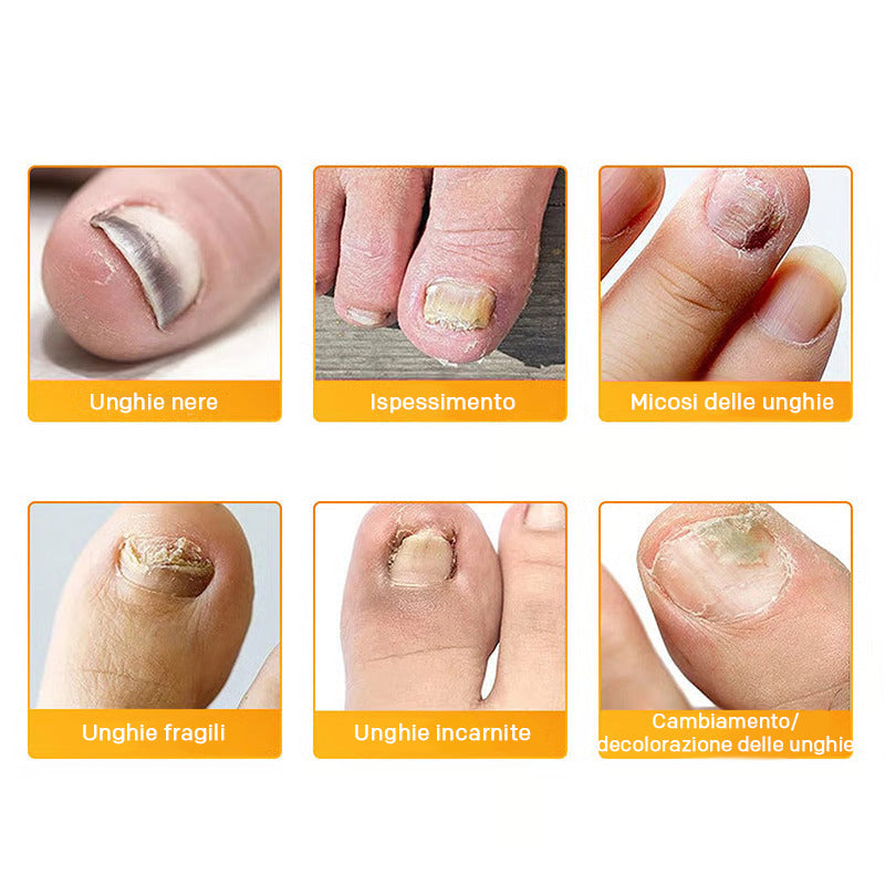 Anti-Pilz Pflaster für Nagelpilz – 21 Stück mit Kräuterformel