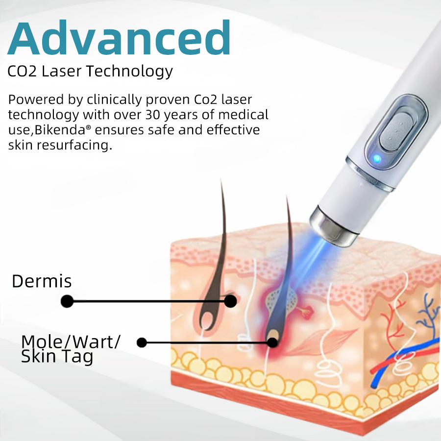 CO₂ Laser Stift – Warzen, Leberflecken & Hautflecken entfernen