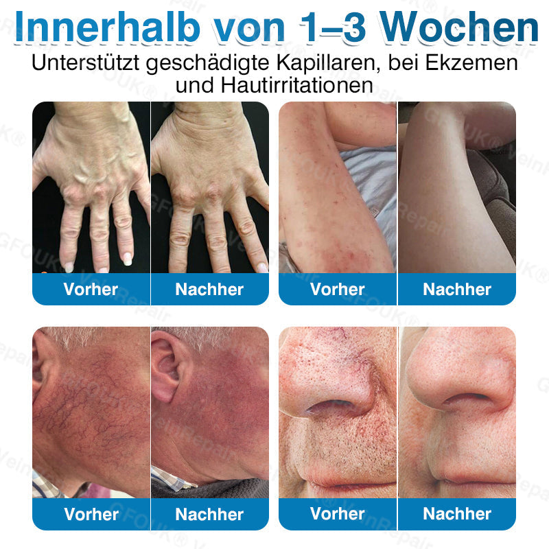Mikronadel-Pflasterrolle für Venen mit Alpinen Pflanzenwirkstoffen