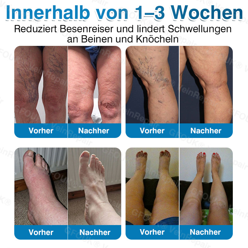 Mikronadel-Pflasterrolle für Venen mit Alpinen Pflanzenwirkstoffen