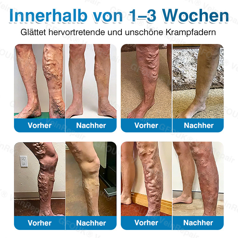 Mikronadel-Pflasterrolle für Venen mit Alpinen Pflanzenwirkstoffen