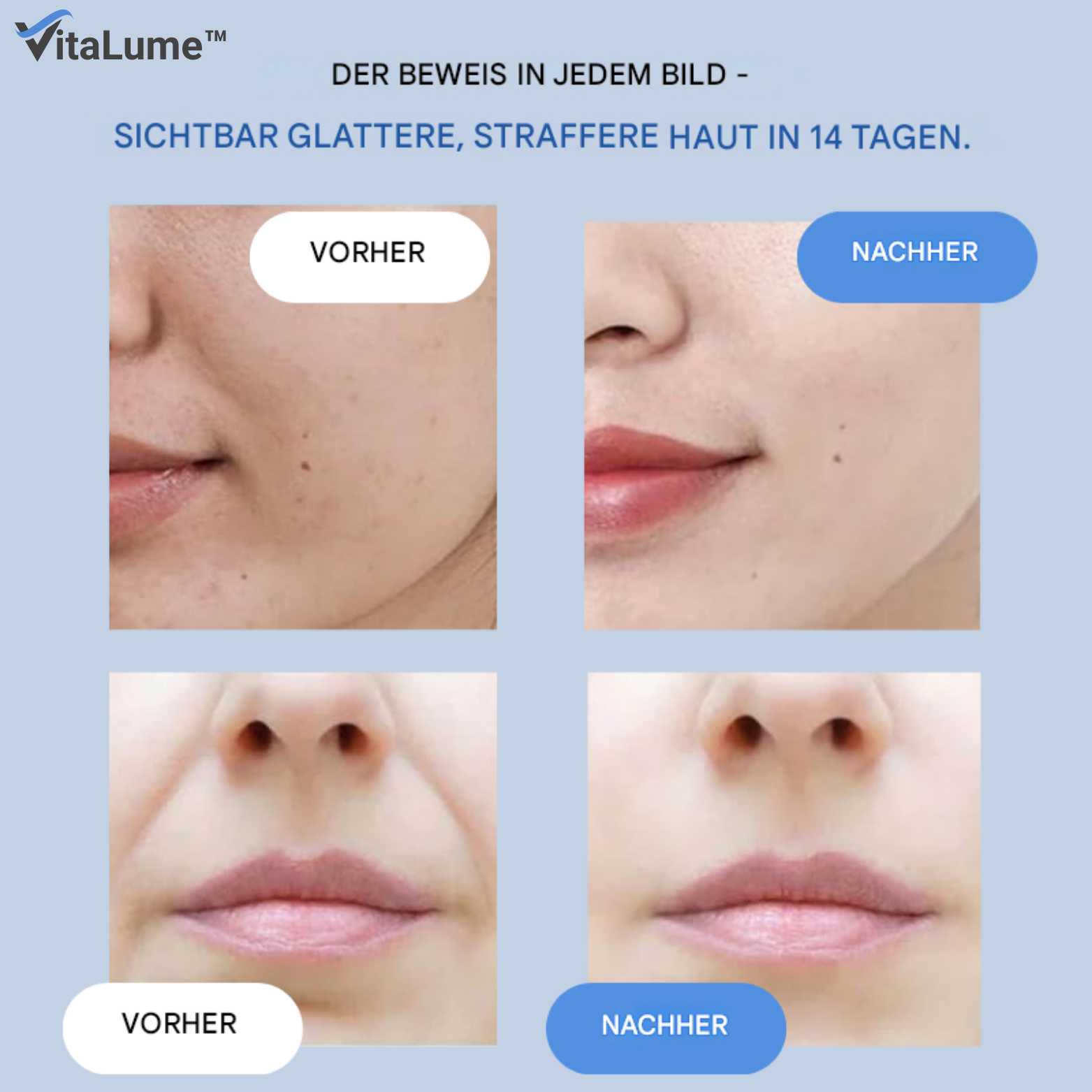 Falten-Patches mit Hyaluronsäure und Mikrokristallen für Anti-Aging