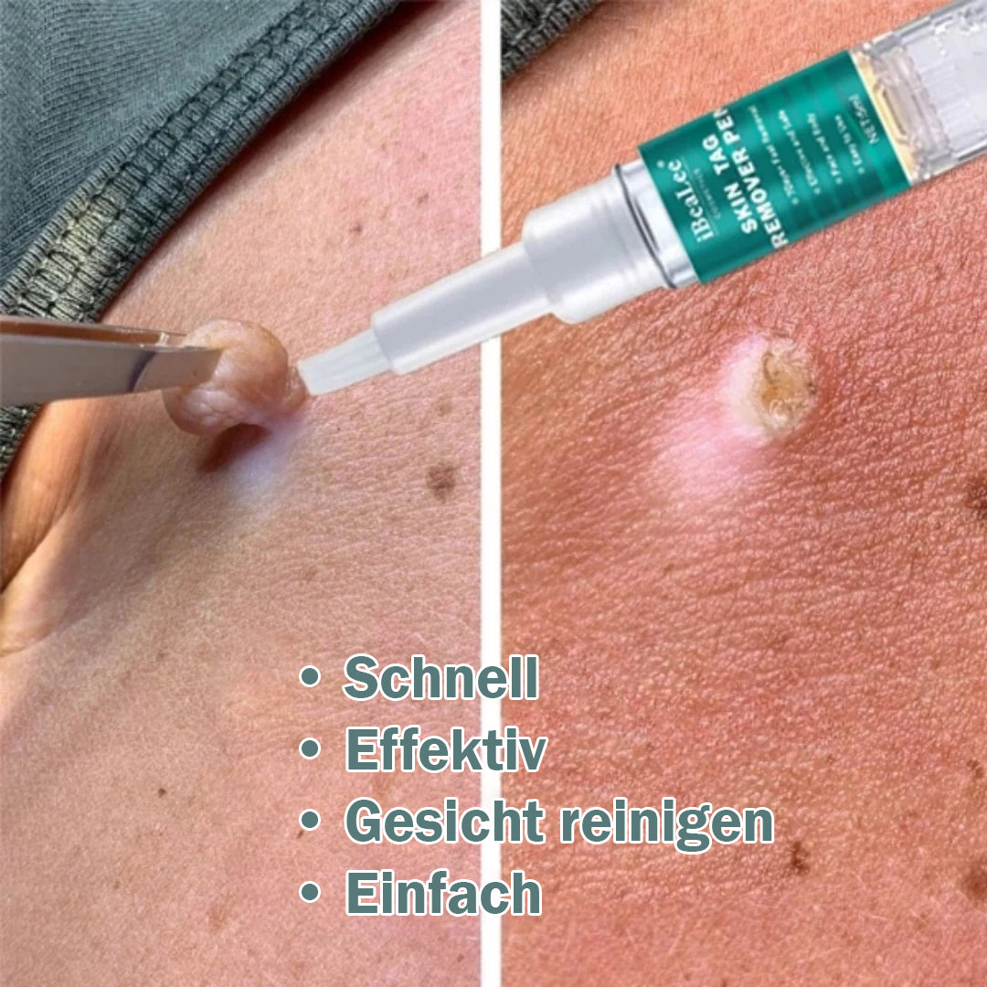 Hautanhängsel Entferner - Natürliche Lösung für Warzen und Muttermale