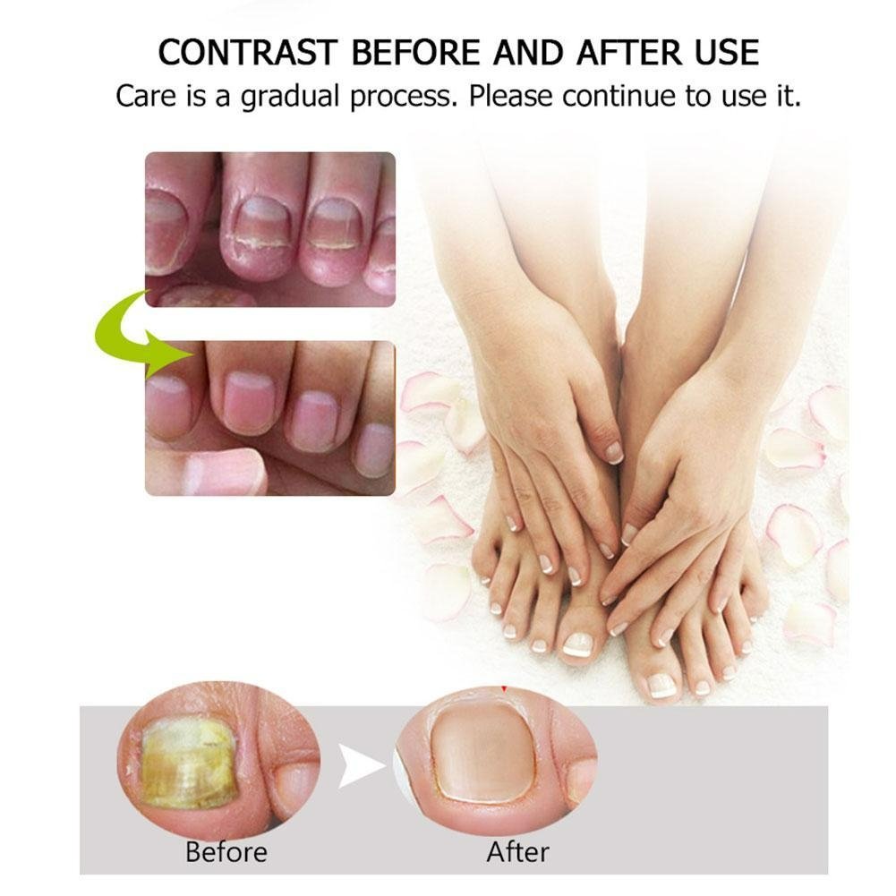 Nagelpflege Gel gegen Pilz - Stärkung und Regeneration für Nägel