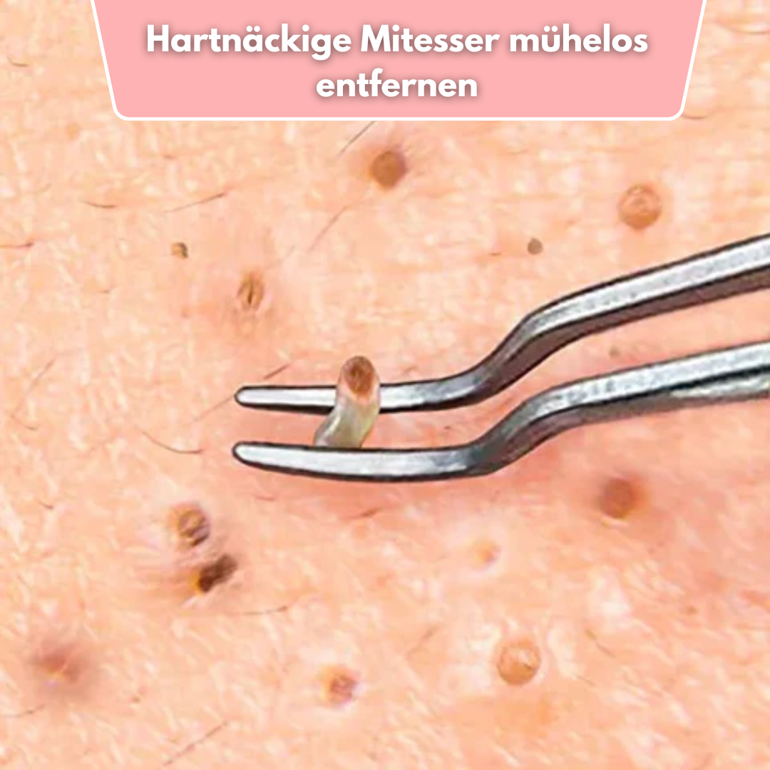 Mitesserentferner Set Pinzetten - Professionelles Hautpflege Werkzeug