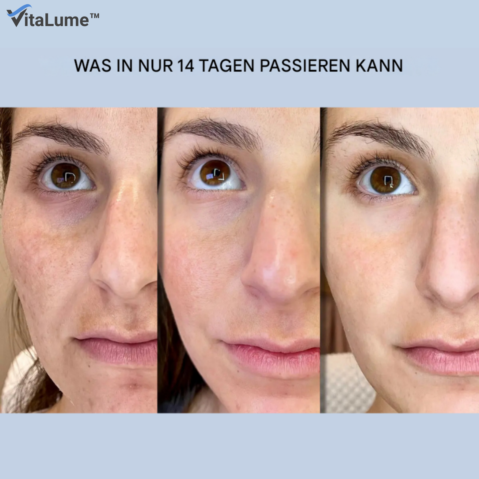 Falten-Patches mit Hyaluronsäure und Mikrokristallen für Anti-Aging