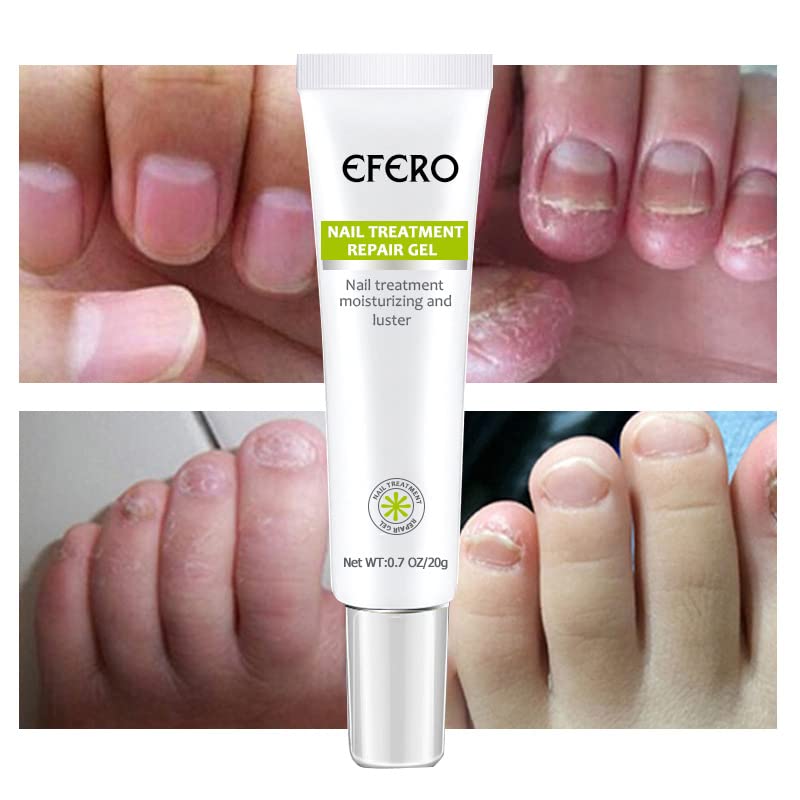 Nagelpflege Gel gegen Pilz - Stärkung und Regeneration für Nägel
