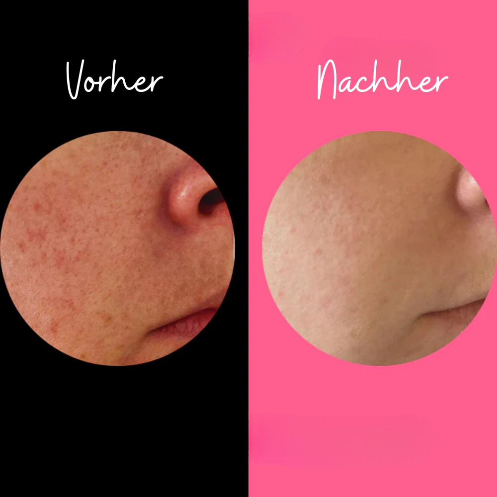 Peeling-Schwamm für empfindliche Haut – Sanftes Körperpeeling ohne Chemie