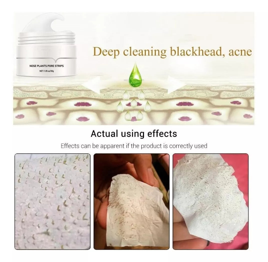 Poren Patches gegen Mitesser - Aktivkohle & Aloe Vera 20 Stück