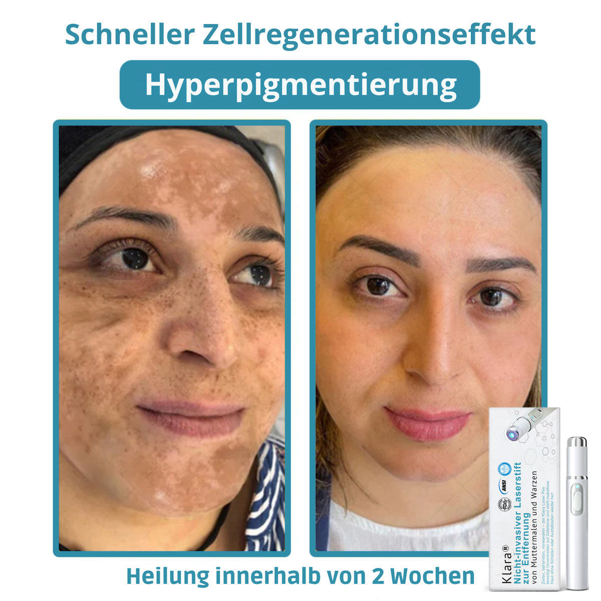 CO₂ Laser Pen für Hautunreinheiten - Warzen & Muttermale entfernen