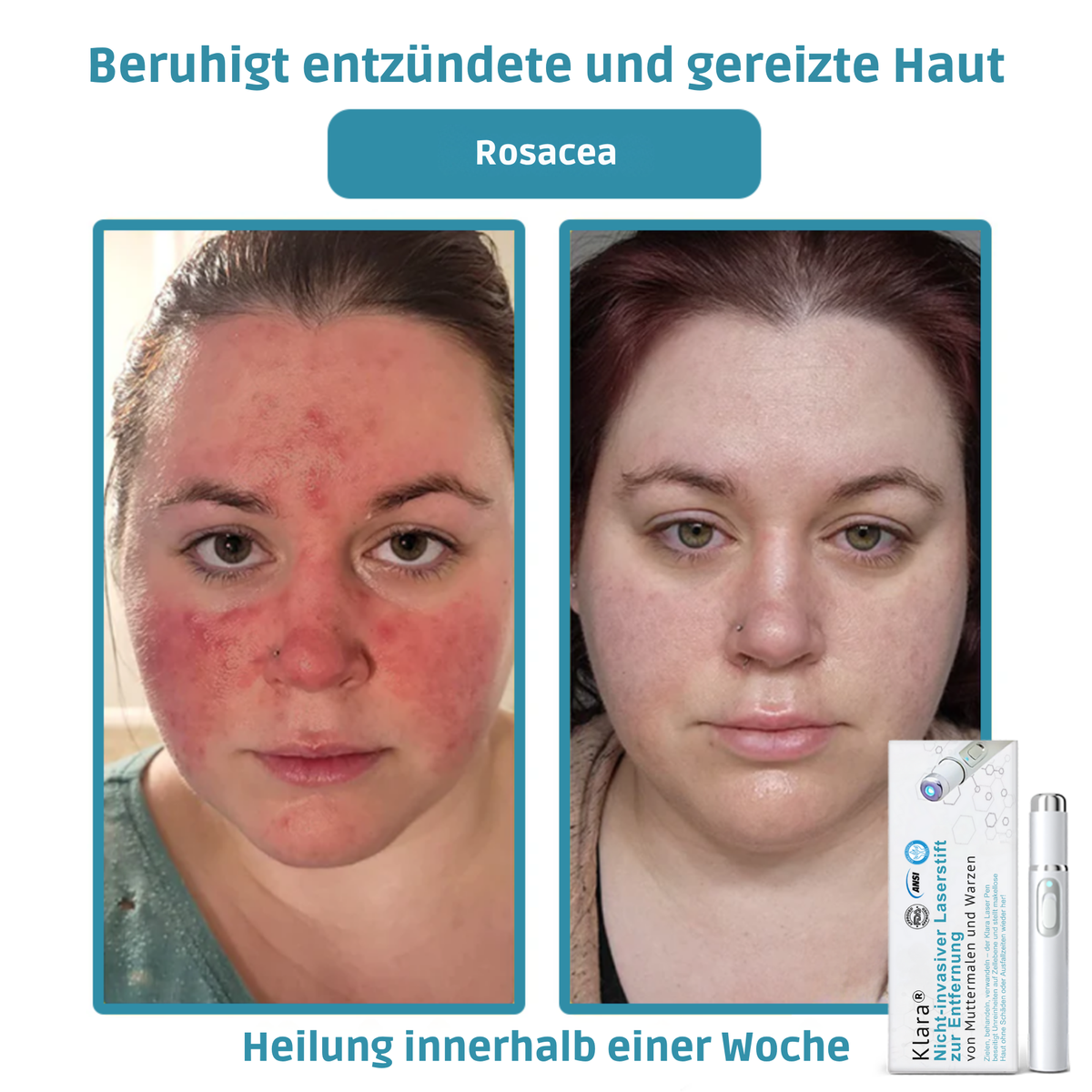 CO₂ Laser Pen für Hautunreinheiten - Warzen & Muttermale entfernen