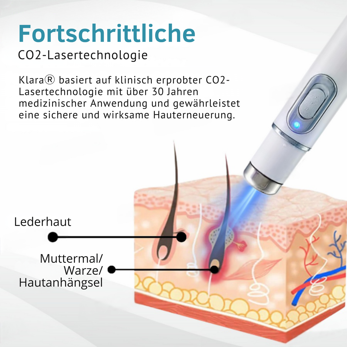CO₂ Laser Pen für Hautunreinheiten - Warzen & Muttermale entfernen