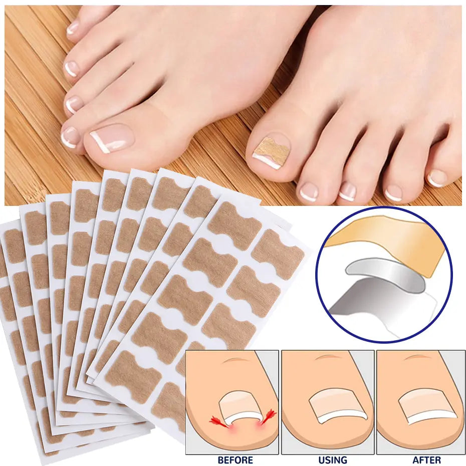 Nagelkorrektur Pads für eingewachsene Nägel - Nagelpflege Set