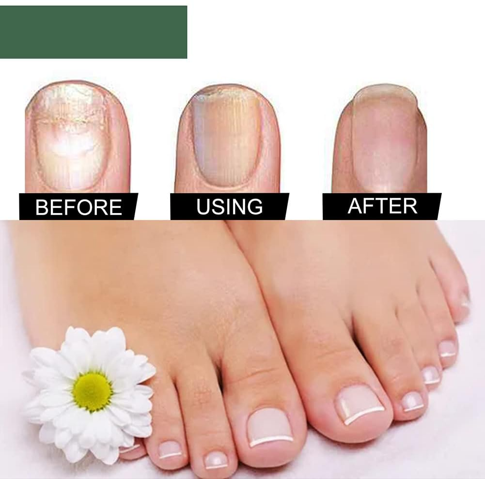 Nagelpilz Reparaturserum – Pflegeserum für gesunde & gepflegte Nägel