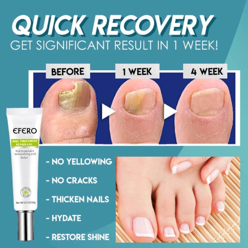 Nagelpflege Gel gegen Pilz - Stärkung und Regeneration für Nägel