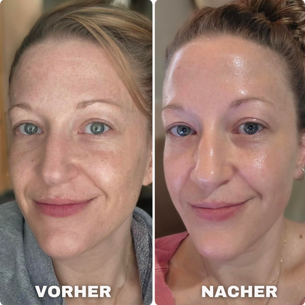 Porentiefe Reinigung Serum mit Salicylsäure - Reis Ampullen Set