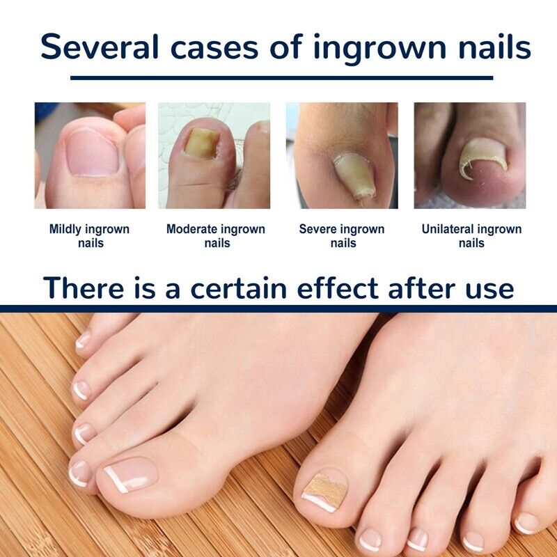 Nagelkorrektur Pads für eingewachsene Zehennägel - 50 Stück
