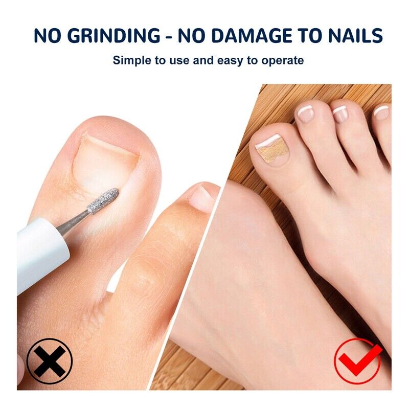 Nagelkorrektur Pads für eingewachsene Zehennägel - 50 Stück